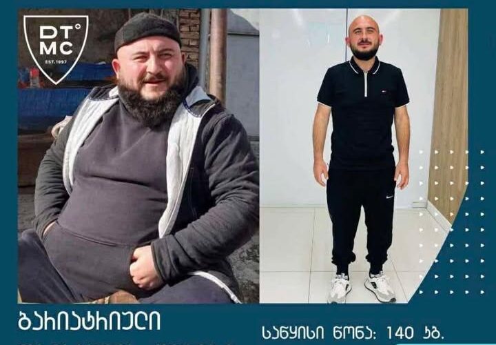ბარიატრიული ოპერაციის შედეგები !